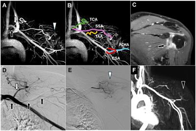 Added value of pre-procedural magnetic resonance angiography in transarterial embolization for refractory musculoskeletal pain